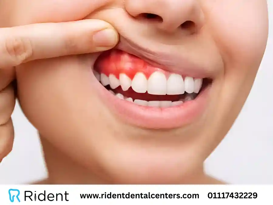   اسباب التهاب اللثة